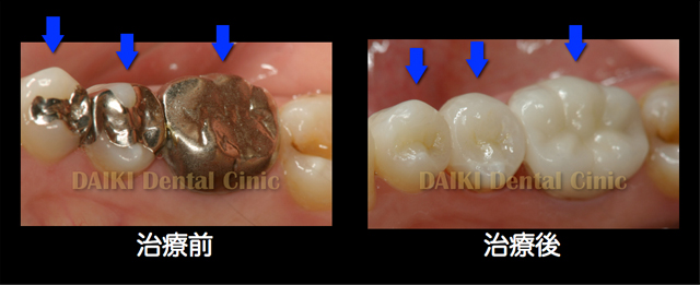 オールセラミッククラウン・インレー