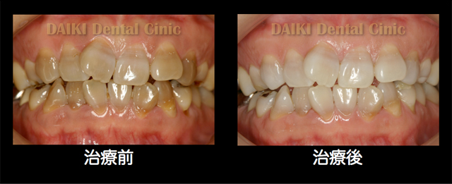 ホワイトニングをお考えの方へ